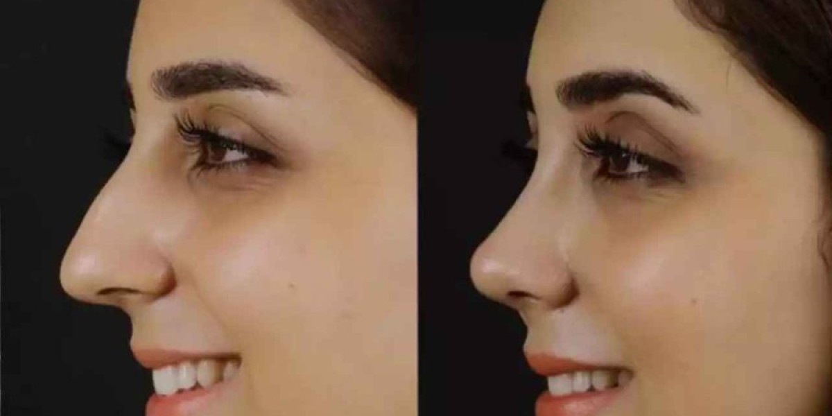 Expert Tips for a Smooth Nose Deviated Septum Surgery in Dubai Recovery