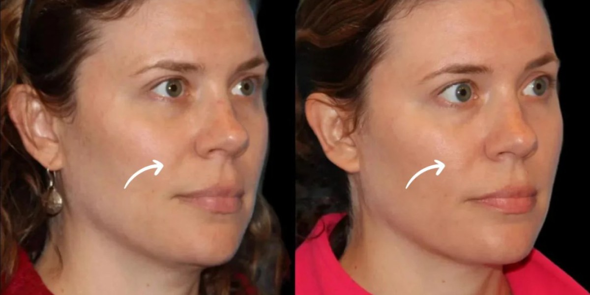 Best Doctors in Dubai for Sculptra Facial Analysis
