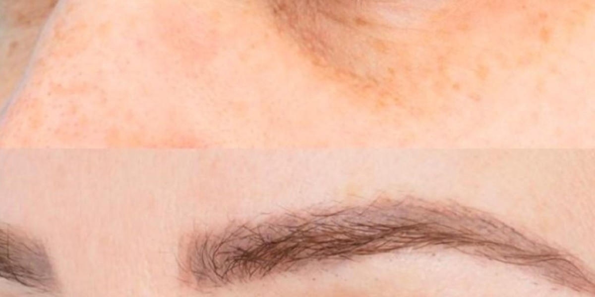 Achieve Naturally Rejuvenated Eyes with Eyelid Surgery in Islamabad