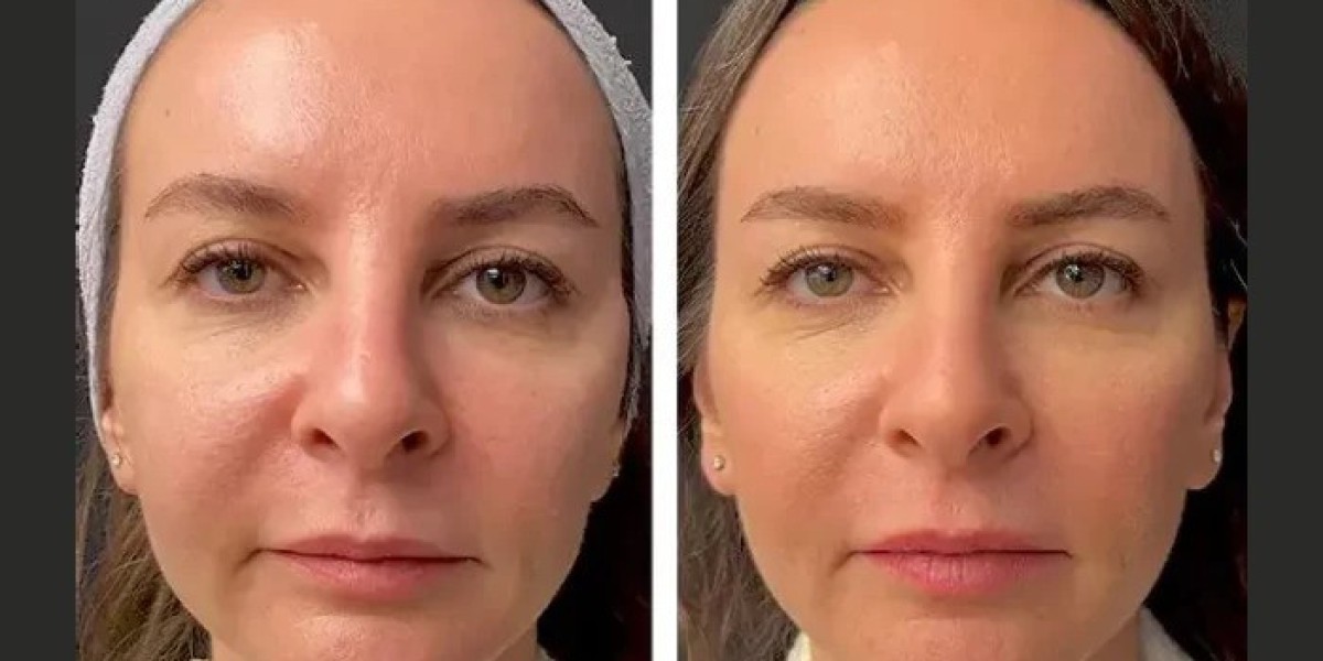 Mesotherapy Treatments in Dubai: How the Procedure Works Step by Step