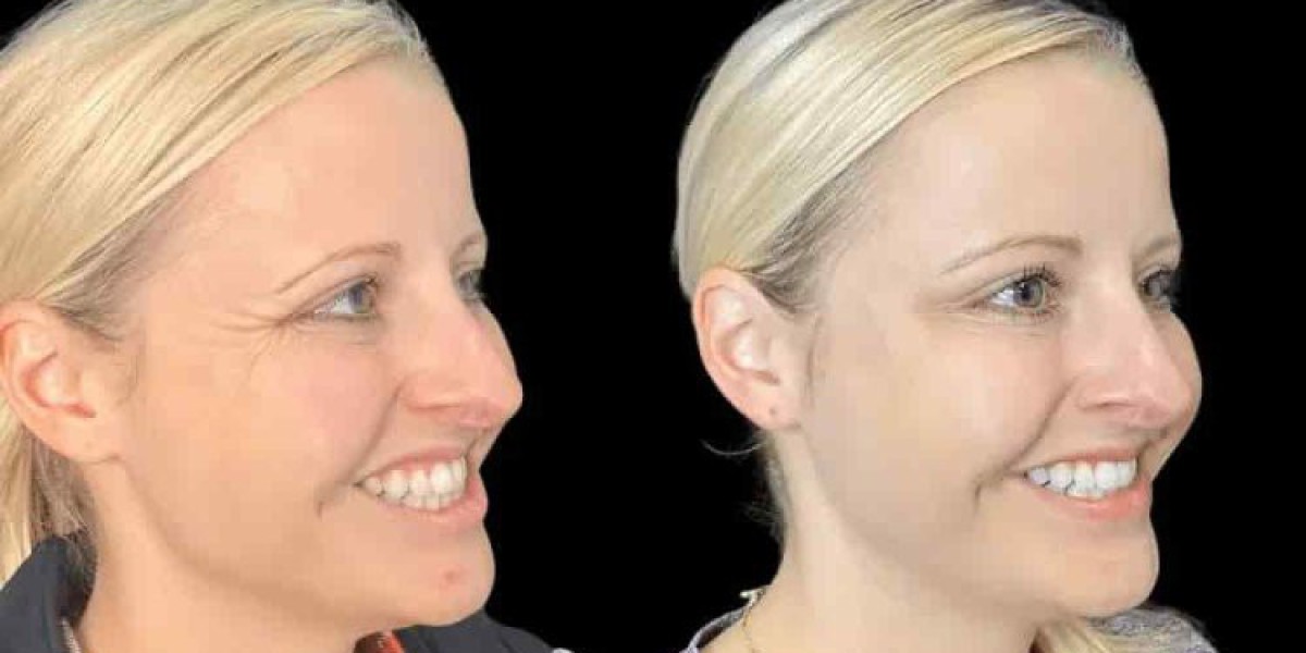 Best Doctors in Dubai for Botox with Customized Cosmetic Solutions