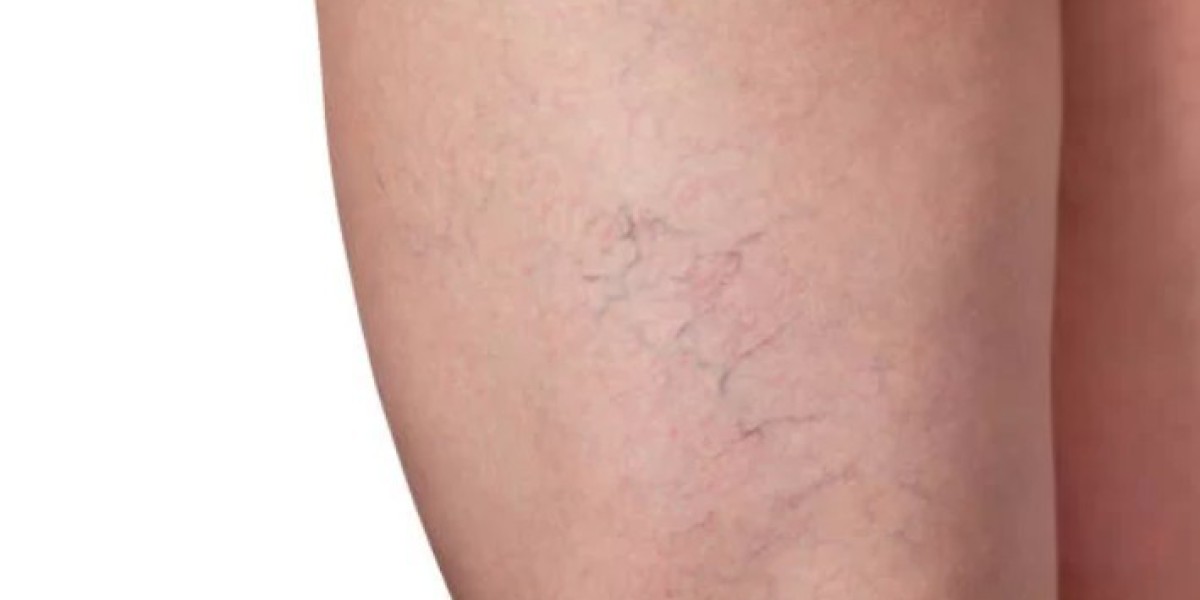 Spider Veins Treatment In Dubai: Modern Solutions for Smoother-Looking Legs