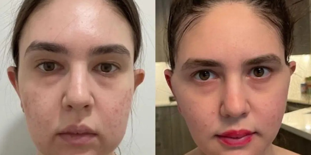 Buccal Fat Removal Facial Refinement Best Doctors in Dubai