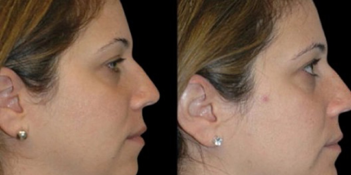 Double chin removal planning with Best Doctors in Dubai