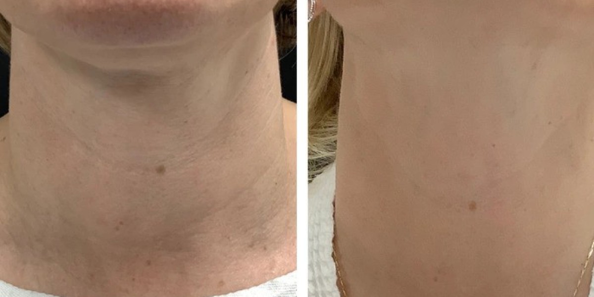Best Aesthetic Clinics in dubai for Radiofrequency Microneedling Results