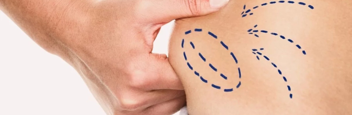 Liposuction Surgery Cover Image